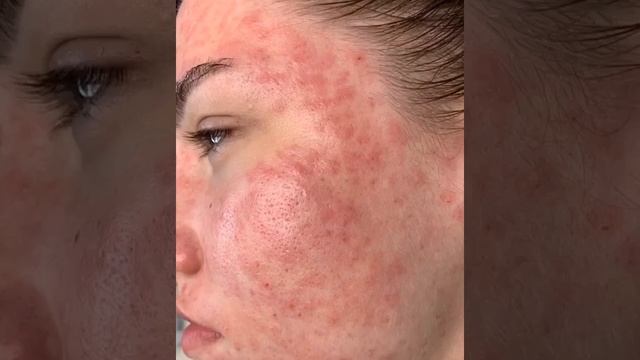 #чисткалица #пилинглица #грозный #москва смотреть онлайн