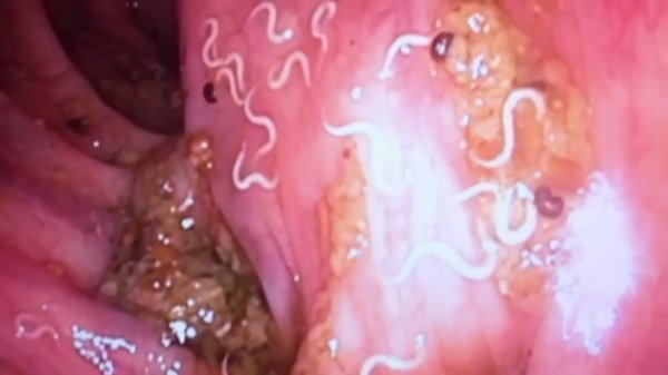 Глисты у человека-паразиты,гельминты,острицы-симптомы у ребенка,признаки у взрослого,лечение глистов