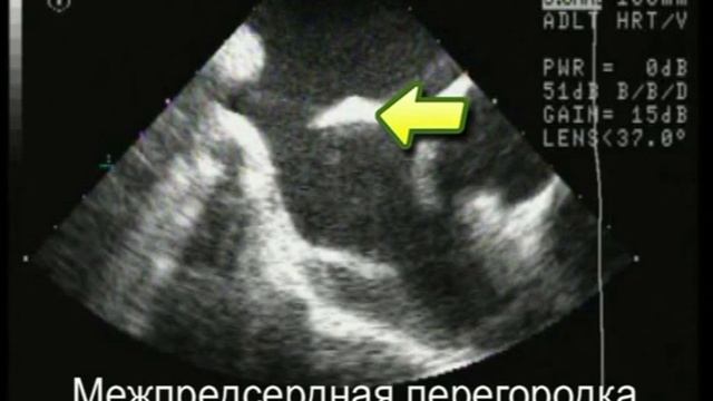 Дефект межпредсердной перегородки sinus venosus (высокий дефект в области устья верхней полой вены) смотреть онлайн