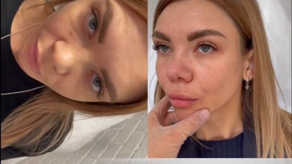 Слёзная борозда + мезорадиес от @all.dr.khalima