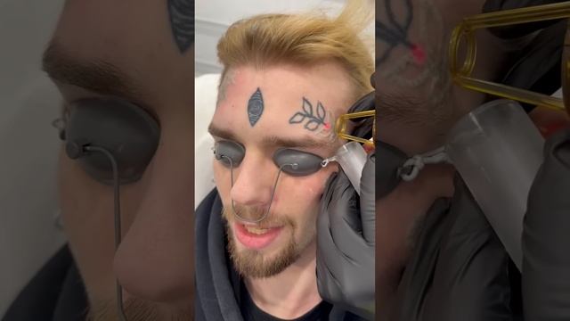Удаляем тату с лица в клинике Sokolov Laser ?? смотреть онлайн