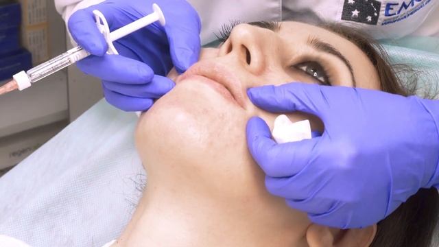 Коррекция губ препаратом Restylane Lip Volume смотреть онлайн
