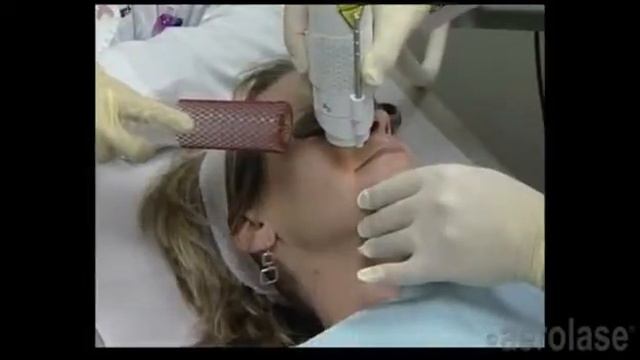 Лазерное абляционное омоложение Friendlylight Era смотреть онлайн