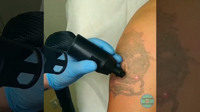 Удаление татуировки Воронеж смотреть онлайн