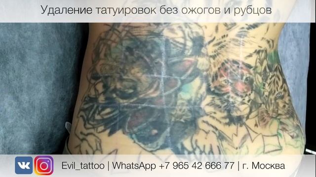 Удалить можно самые сложные татуировки! смотреть онлайн