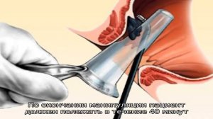 Лазерное удаление геморроя