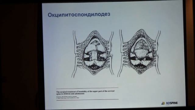 10 Александр Губин Технические аспекты задней фиксации шейного отдела позвоночника смотреть онлайн