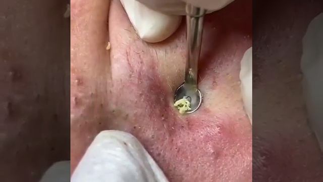 #Прыщи #Угри #Акне