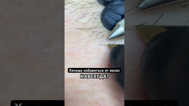 Электроэпиляция Краснодар ГМР | 89937724158 смотреть онлайн