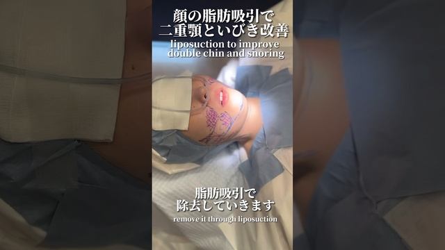 顎下脂肪吸引で二重顎といびきも改善！？#short смотреть онлайн