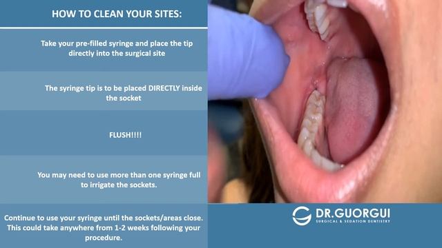 Post-Operative Video: Irrigation for Extraction and Wisdom Teeth смотреть онлайн
