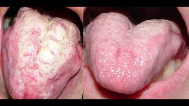 Oral Thrush Compares-Very bad case of thrush. смотреть онлайн