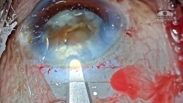 Hypermature cataract , an imposter- MSICS to the rescue - Dr Deepak megur смотреть онлайн