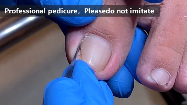 Pedicure tutorial ：Completely cure paronychia【Xue Yidao】 смотреть онлайн