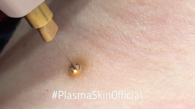 Удаление папиллом. PlasmaSkinEducation смотреть онлайн