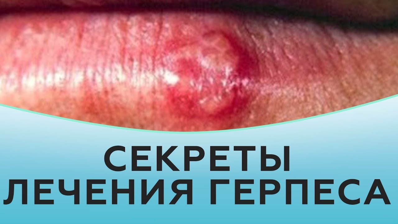 Секреты лечения герпеса. смотреть онлайн