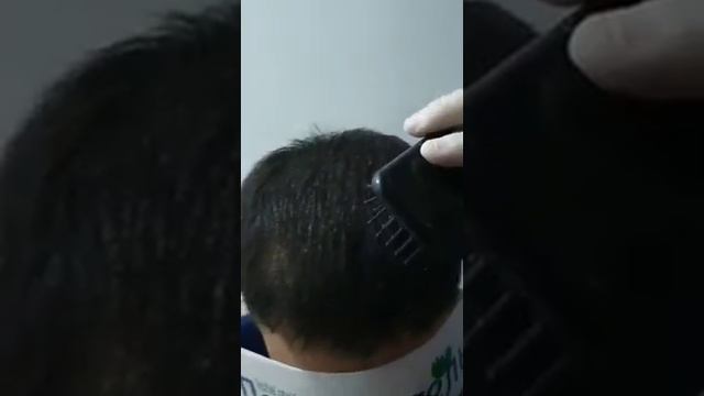 Пересадка волосы УЗБЕКИСТАНЕ ТЕЛЕФОН ☎+998970004898 ДОКТОР ТРИЕХОЛОК смотреть онлайн