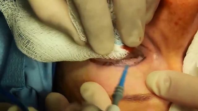 Блефаропластика век смотреть онлайн