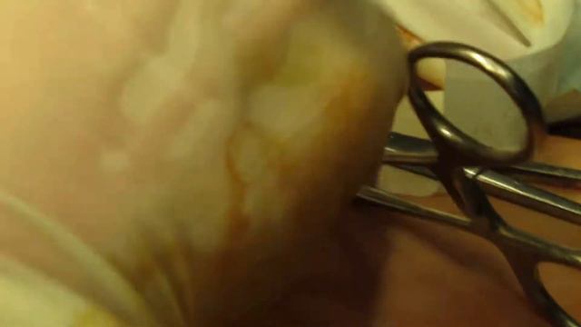 Phlebectomia, crossectomia + GSV stripping+crossing perforator veins смотреть онлайн