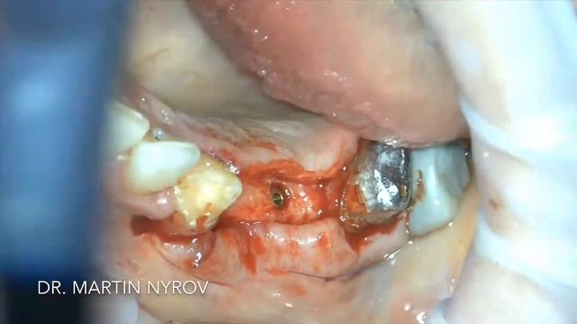Установка имплантатов с наращиванием объема костной ткани смотреть онлайн