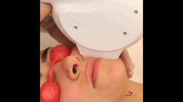 Hair Removal on Upper Lip and Chin смотреть онлайн