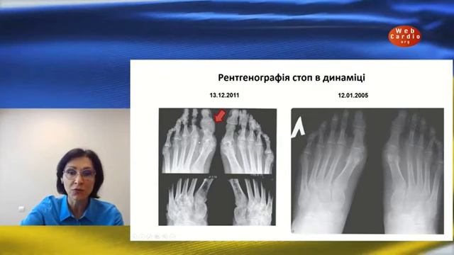 Сучасне лікування подагри: як змінити прогноз у коморбідного пацієнта? Гарміш О.О. смотреть онлайн