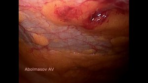 лапароскопическое подшивание матки и влагалища (non edited video)