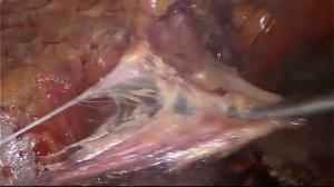 Лапароскопическая герниопластика ТАРР - 5