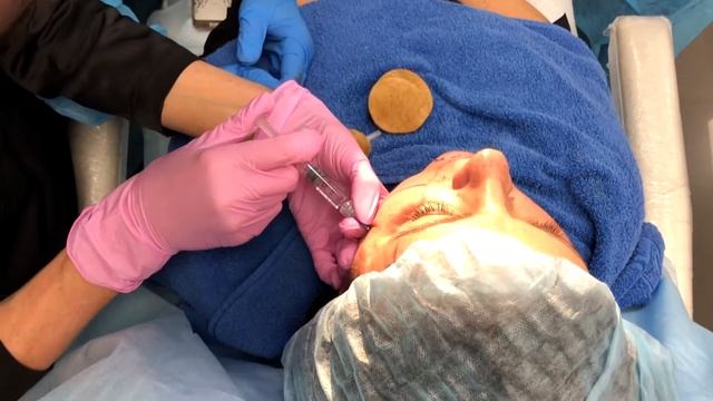 Контурная пластика скул Repleri. Отзыв о процедуре смотреть онлайн