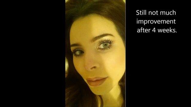 Careprost Review (generic Latisse) How I Grew My Lashes Thick and Long смотреть онлайн