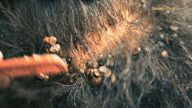 Satisfying Remove Giant Lice / Ticks Headache poor # 193 смотреть онлайн