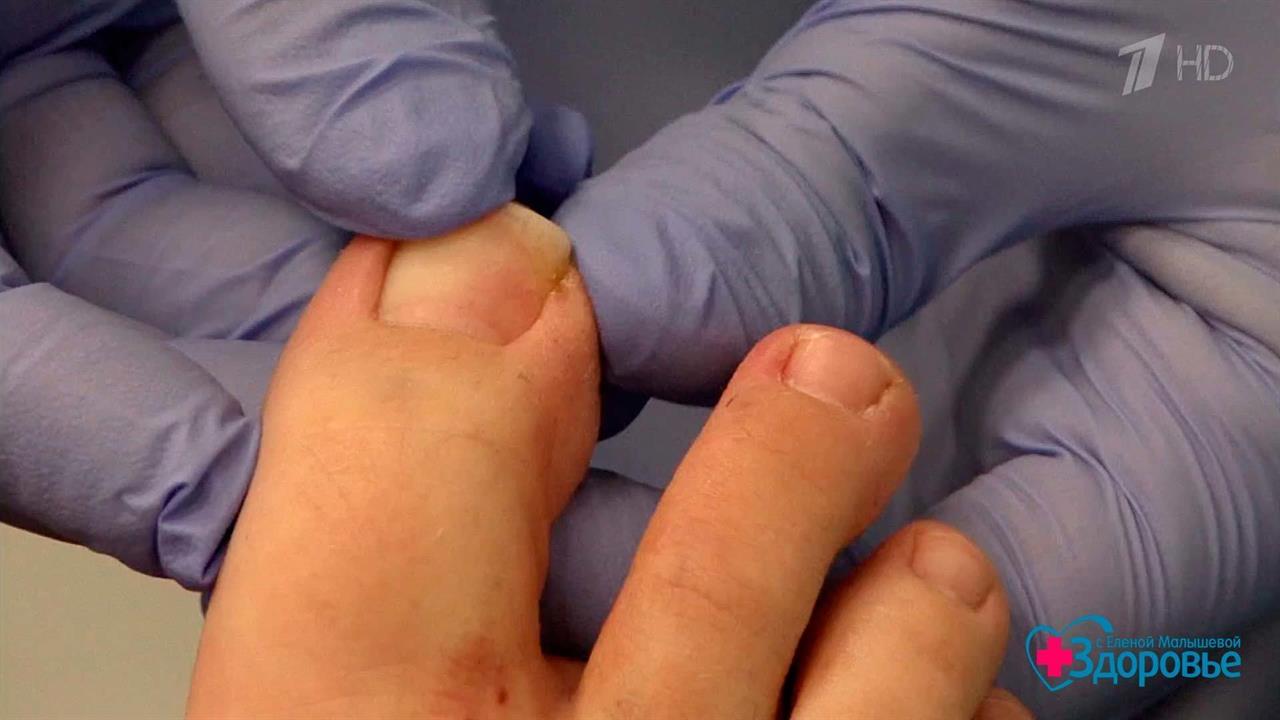 Вросший ноготь на большом пальце. Здоровье. Фрагмент выпуска от 10.09.2017 смотреть онлайн