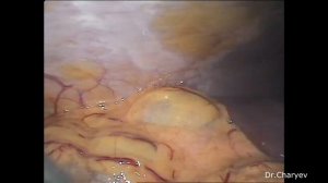 Дивертикул Меккеля. Лапароскопическое удаление.