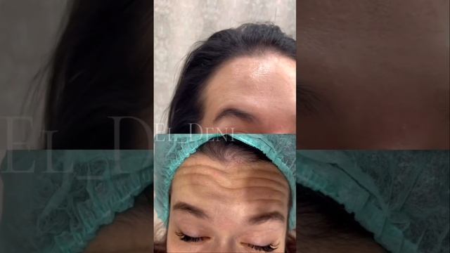 Обучение инъекционной , лазерной и эстетической косметологии. Техники Russian lips, Плоский бант . смотреть онлайн