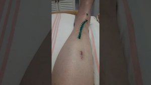 ПЕРЕЛОМ БОЛЬШОЙ БЕРЦОВОЙ КОСТИ