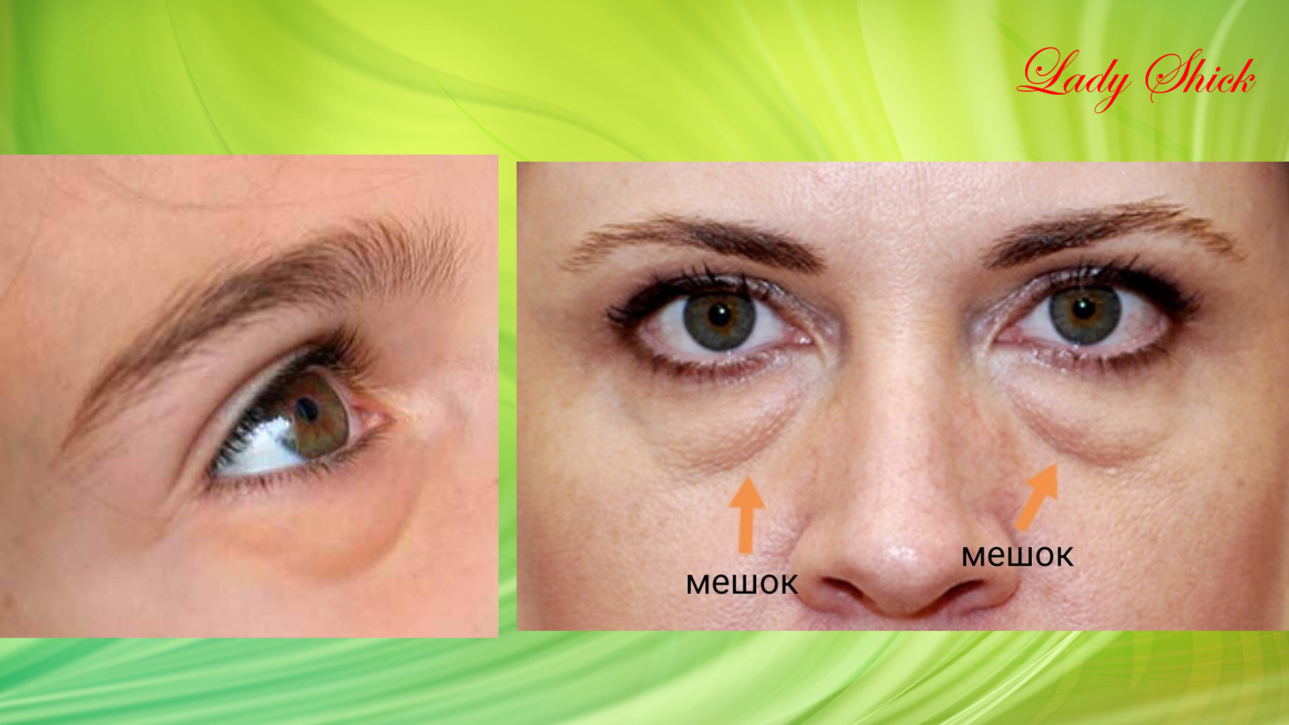 Отёки и мешки под глазами. Часть 1: причины. Всегда ли помогают патчи для глаз. смотреть онлайн