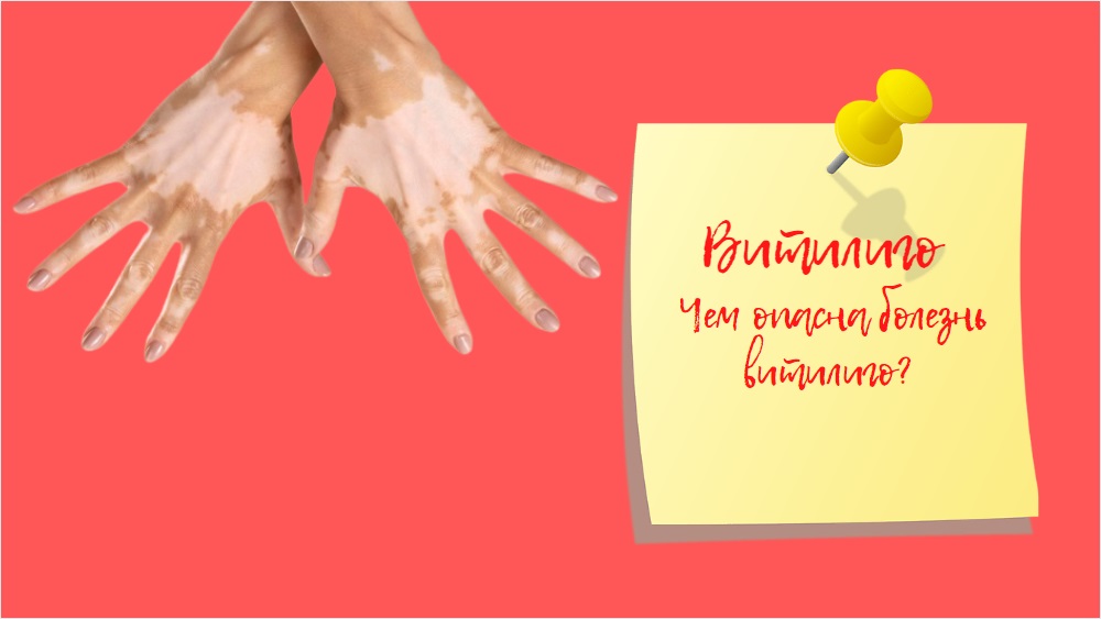 Витилиго  |  Чем опасна болезнь витилиго?