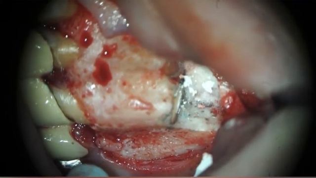 Apical tooth microsurgery 2.2,2.3 Апикальная микрохирургия зуба 2.2,2.3 смотреть онлайн