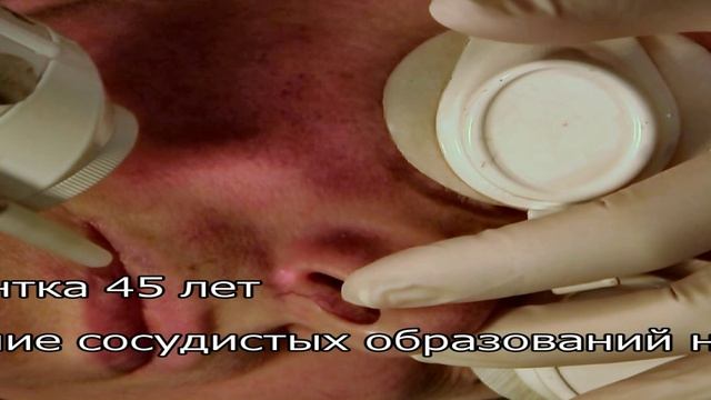 Удаление сосудистых образований на лице смотреть онлайн