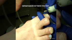 Установка BS пластины для коррекция вросшего ногтя