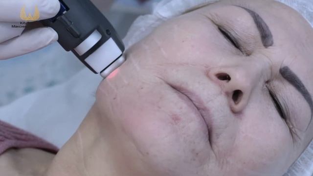 Лазерное лифтинг-омоложение смотреть онлайн