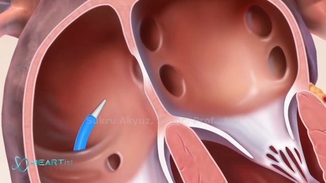 Repairing a Leaky Heart Valve without Surgery: Mitral Valve Clip (MitraClip) смотреть онлайн