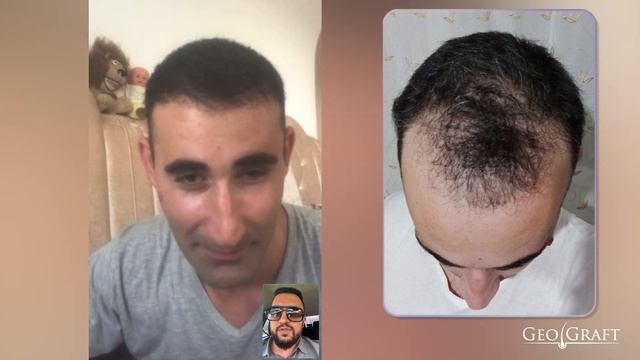 РАННИЙ РЕЗУЛЬТАТ ПЕРЕСАДКИ ВОЛОС В МОСКВЕ смотреть онлайн