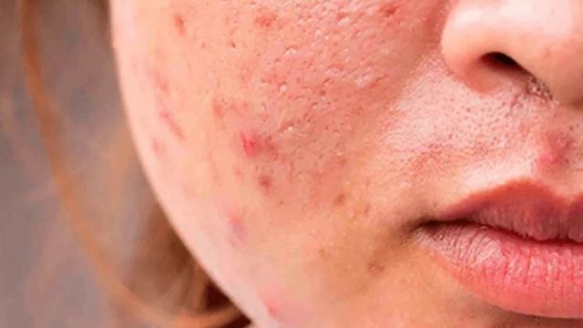 Какие продукты вызывают прыщи смотреть онлайн