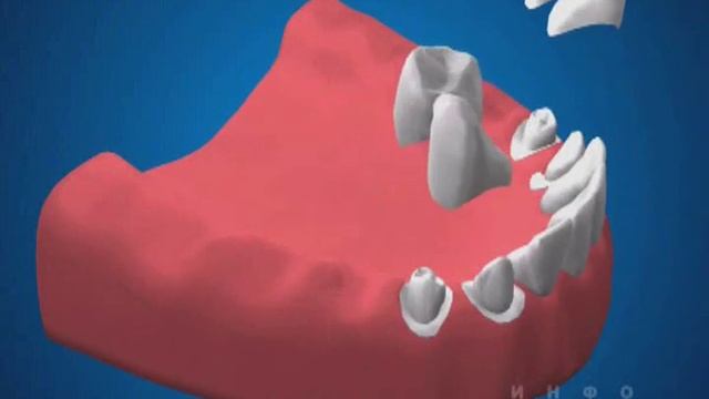 Бюгель на аттачменах. Сьемное протезирование зубов. смотреть онлайн