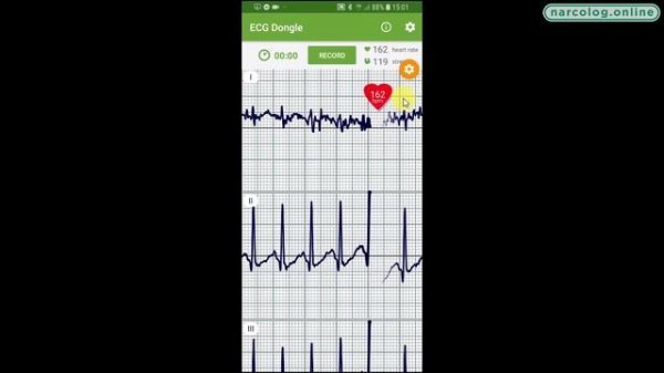 Тест обзор. ЭКГ vs Garmin HRM RUN