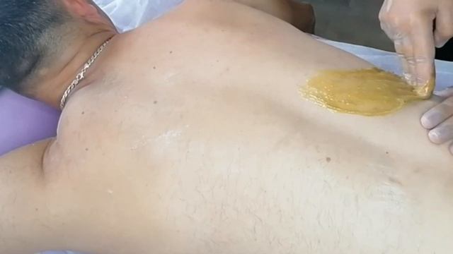 УДАЛЕНИЕ ВОЛОС НА СПИНЕ У МУЖЧИНЫ. смотреть онлайн