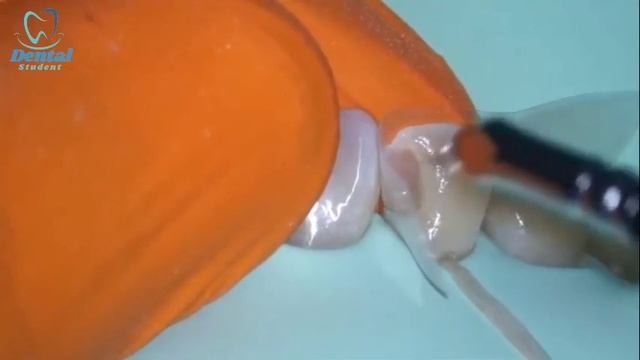 Free hand Class III palatal shell build up смотреть онлайн