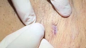 Armpit (axillae) extractions. Blackheads, whiteheads. Oxidized Keratin Plugs in pores removed.
