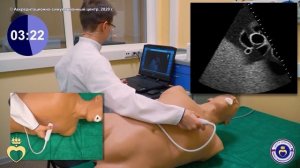 ЭХО КГ. Парастернальный доступ - короткая ось на уровне аортального клапана